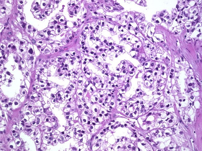 cell Vaginal carcinoma clear