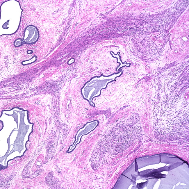 Uterus_EndocervicalAdenomyoma1.jpg