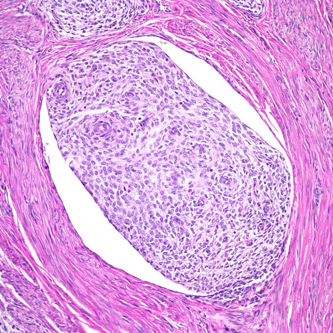 Uterus_EndometrialStromalSarcoma_VascularInvasion2.jpg