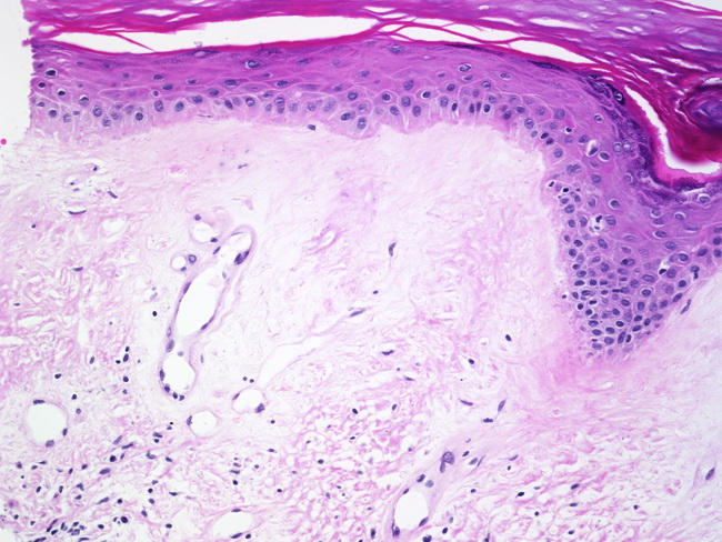 lichen planus histology #10