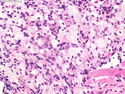 Pathology Outlines - Xanthoma cells