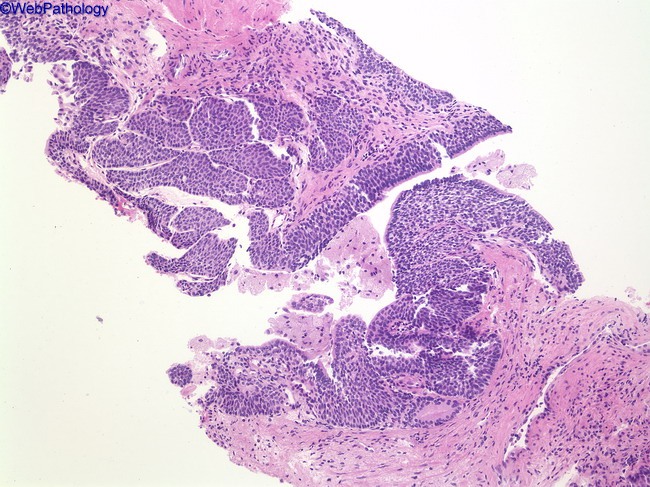 Urothelial papilloma pathology outlines
