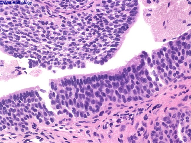 urothelial metaplasia prostate pathology
