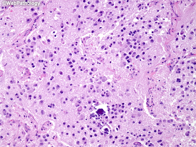 Adrenal_Neuroblastoma25_Diff.jpg