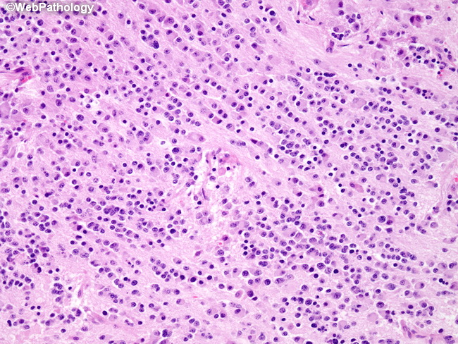 Adrenal_Neuroblastoma29_Diff.jpg