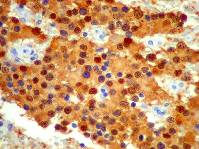 Adrenal_Neuroblastoma6_NSE_UNICAMP_resized.jpg