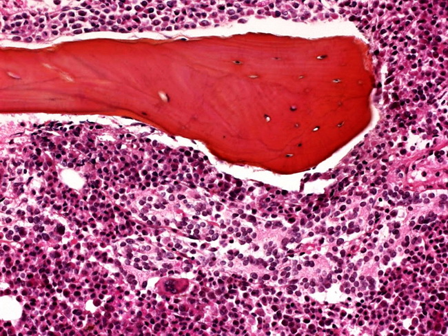 Adrenal_Neuroblastoma_BM.jpg