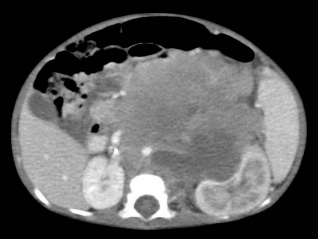 Adrenal_Neuroblastoma_Imaging1_CT_Resized.jpg