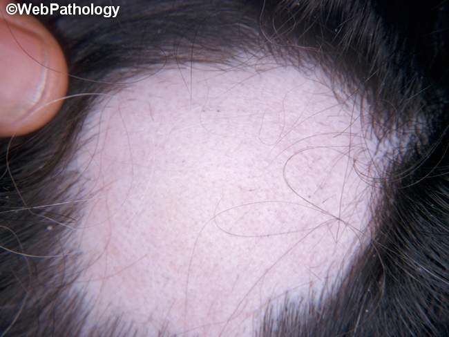 Alopecia1_areata.jpg