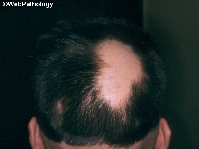 Alopecia7_areata.jpg