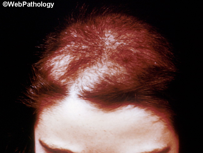 Alopecia8_Trichotillomania.jpg