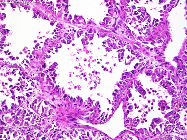 AlveolarSoftPartSarcoma16.jpg