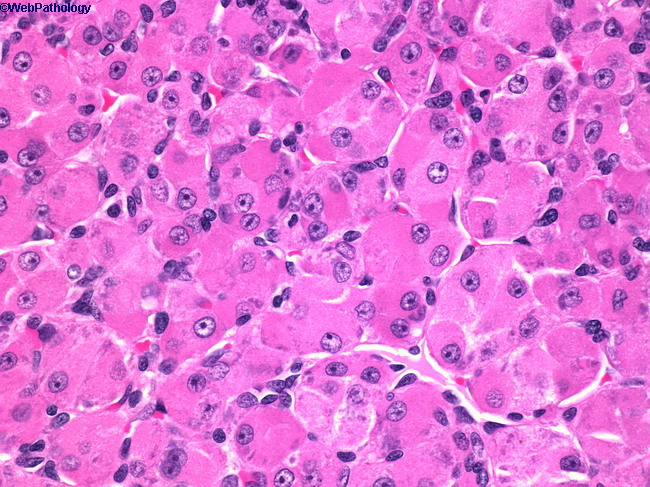 AlveolarSoftPartSarcoma_Oropharynx2.jpg