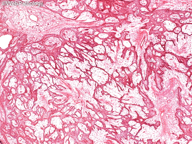 Ameloblastoma1_Plexiform.jpg