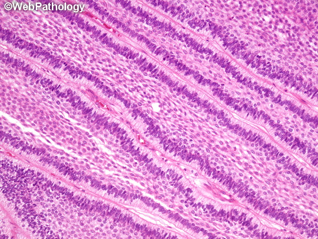 Ameloblastoma23A.jpg