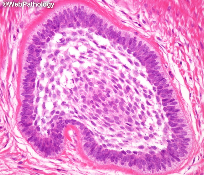 Ameloblastoma25A.jpg