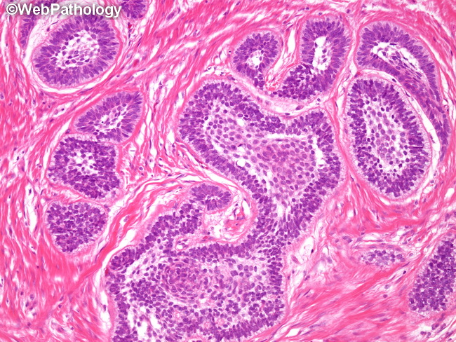 Ameloblastoma26A.jpg