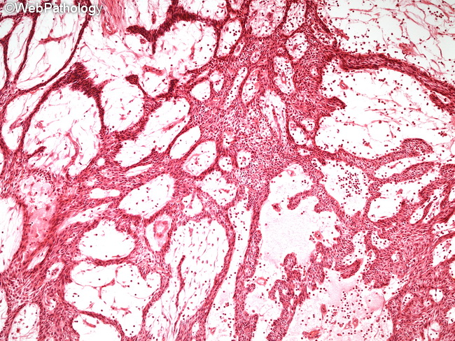 Ameloblastoma2_Plexiform.jpg