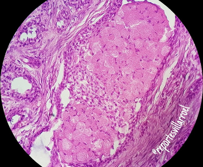 Ameloblastoma30_Granular.jpg