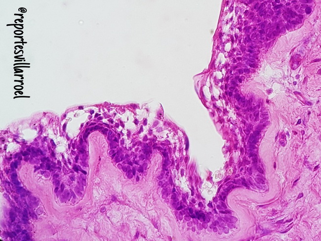 Ameloblastoma35_Unicystic_resized.jpg