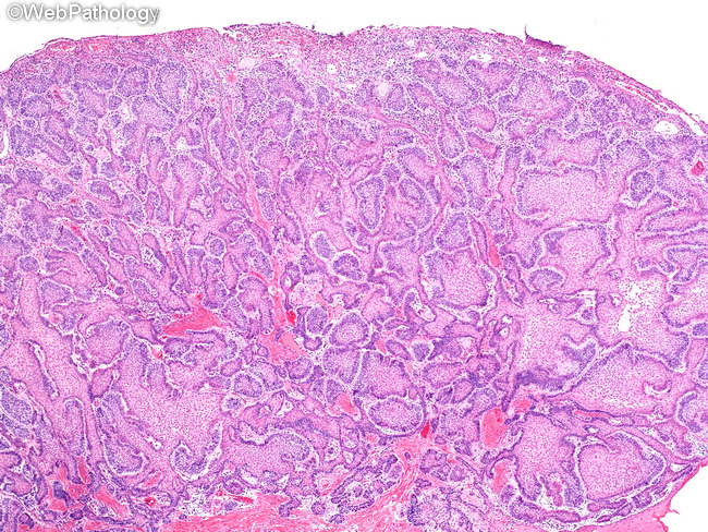 Ameloblastoma_Extraosseous9_OralCavity.jpg