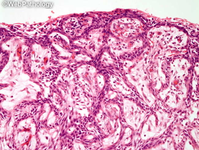 Ameloblastoma_Mandible_Cystic3.jpg