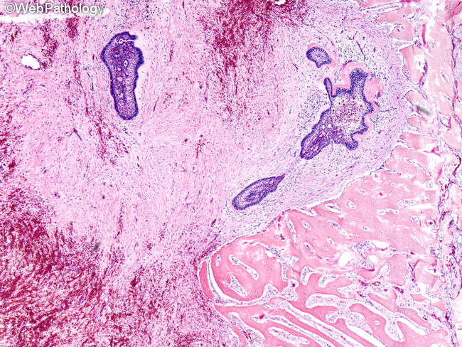 Ameloblastoma_Mandible_Desmoplastic1.jpg