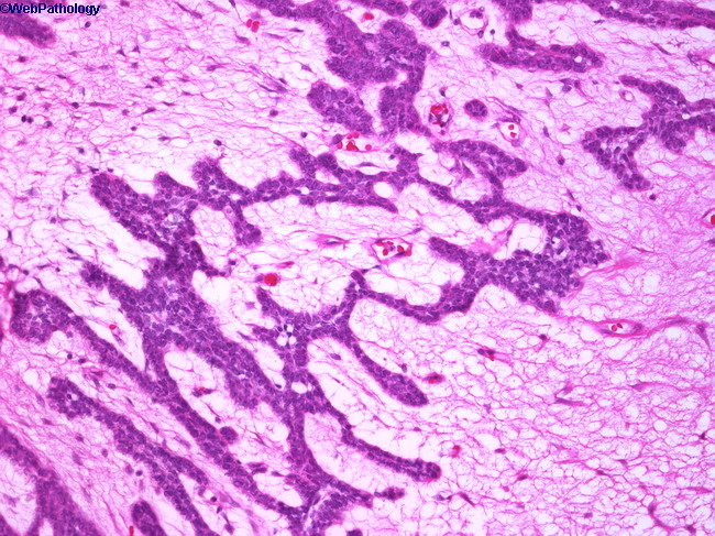 Ameloblastoma_Maxilla1.jpg