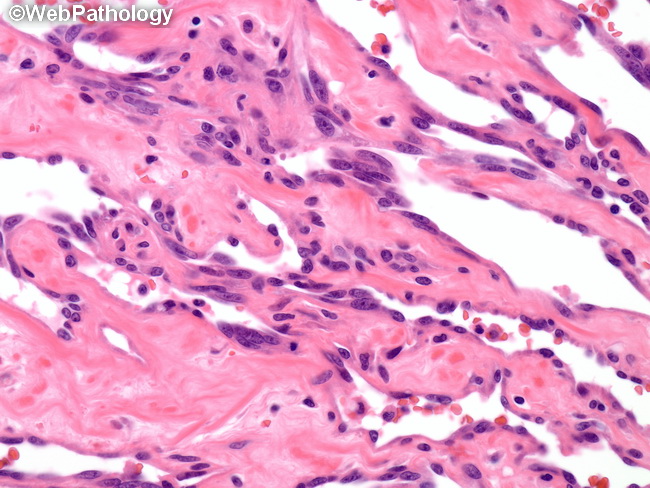 Angiosarcoma110_Kidney.jpg