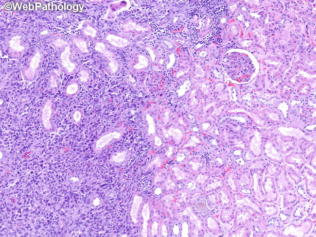 Angiosarcoma111_Kidney.jpg