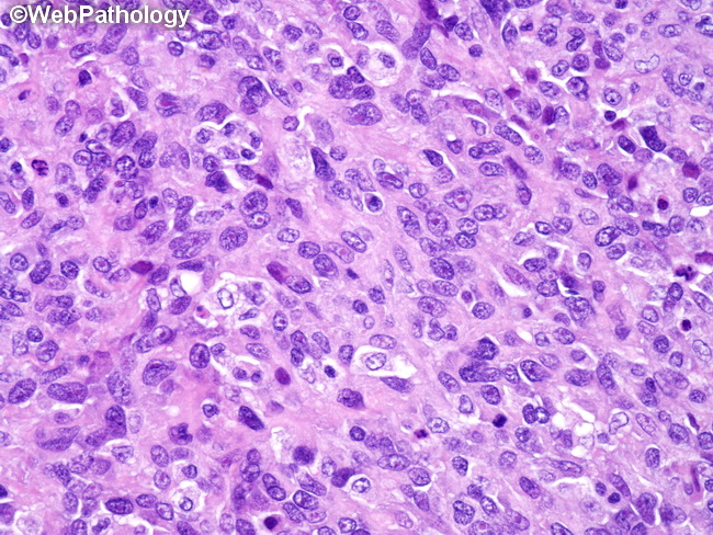 Angiosarcoma114_Kidney.jpg