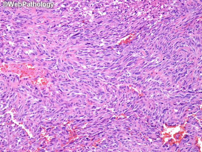 Angiosarcoma116_Kidney.jpg