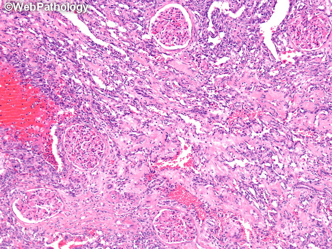 Angiosarcoma121_Kidney.jpg