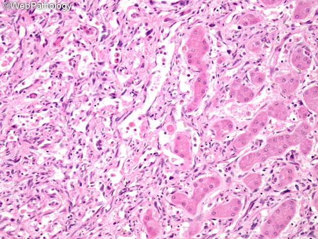 Angiosarcoma122_Liver.jpg