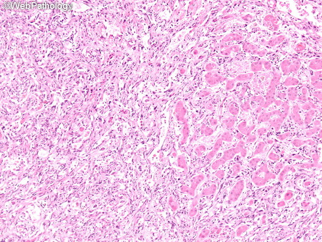 Angiosarcoma123_Liver.jpg