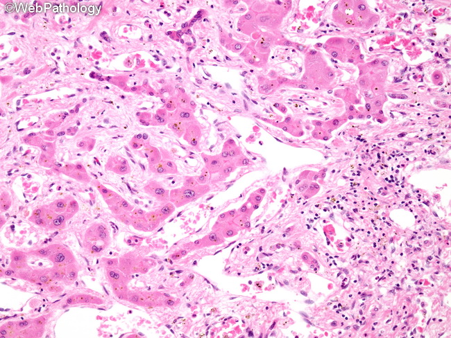Angiosarcoma124_Liver.jpg