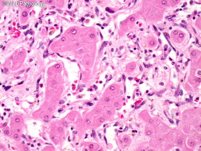 Angiosarcoma126_Liver.jpg