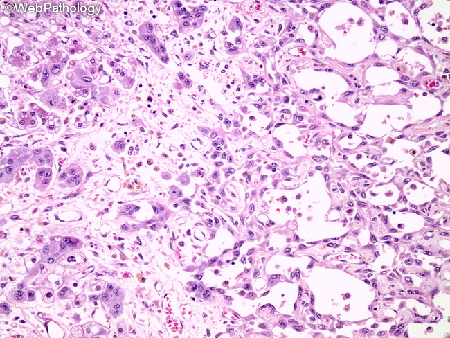 Angiosarcoma127_Liver.jpg