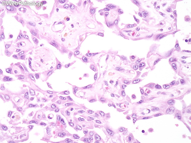 Angiosarcoma130_Liver.jpg
