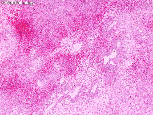 Angiosarcoma131_Liver.jpg