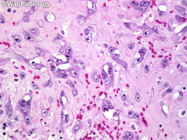Angiosarcoma19_Breast_PostRadiation.jpg