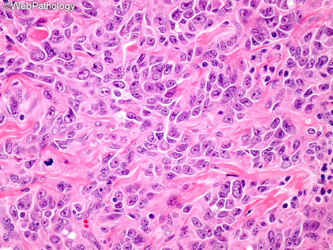 Angiosarcoma34_Cutaneous.jpg