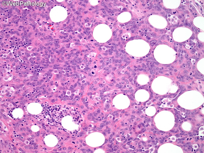 Angiosarcoma35_Cutaneous.jpg