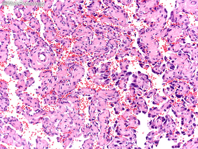 Angiosarcoma52_Breast.jpg