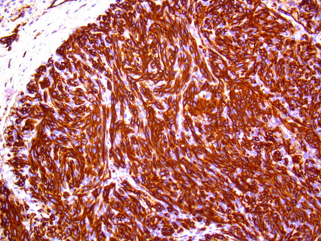 Angiosarcoma77_CD31_Resized.jpg