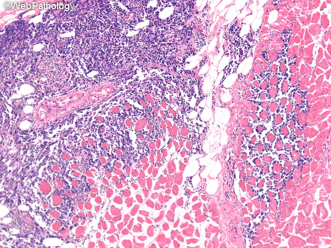 Angiosarcoma78_Breast_PostRadiation.jpg