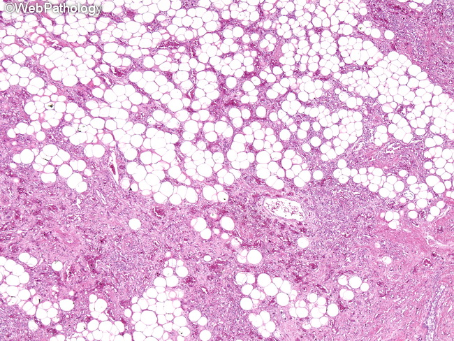 Angiosarcoma80_Breast.jpg