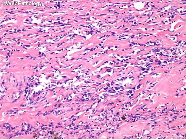 Angiosarcoma80_Breast_PostRadiation.jpg