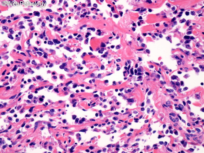 Angiosarcoma81_Breast_PostRadiation.jpg
