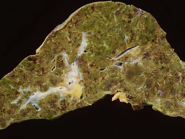 Angiosarcoma_Gross_Liver1_cropped.jpg